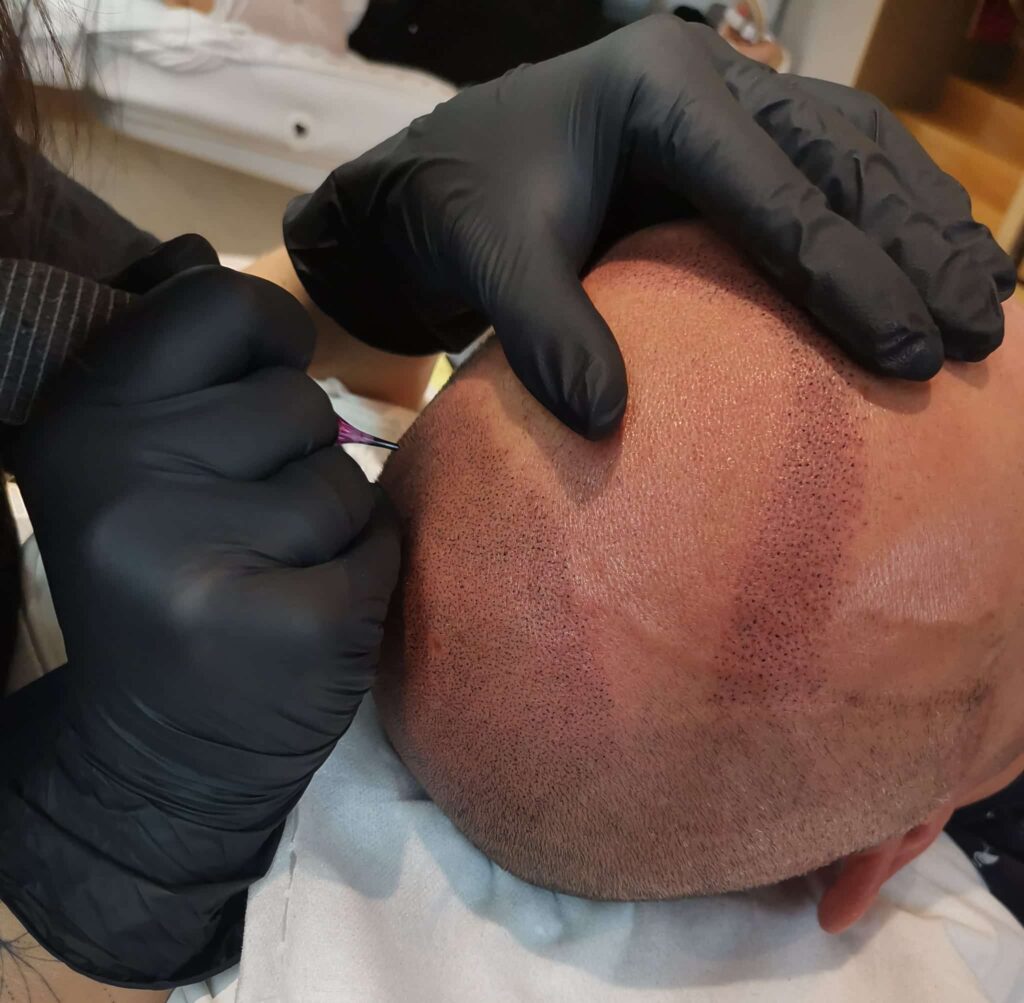 Micropigmentation des cheveux sur crane rasé