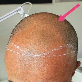 Effet rasé micropigmentation