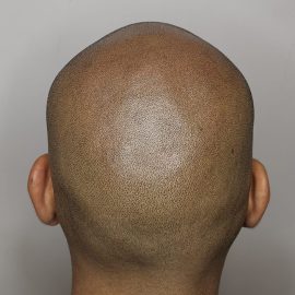 Micropigmentation apres